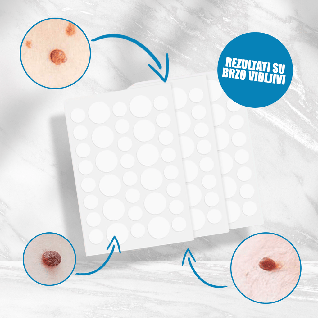 Flasteri za uklanjanje bradavica 3+1 GRATIS