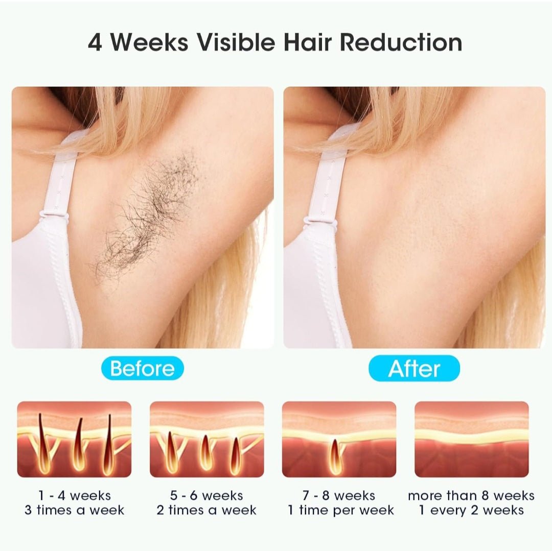 Uređaj za Lasersku Epilaciju s Ledenim Učinkom